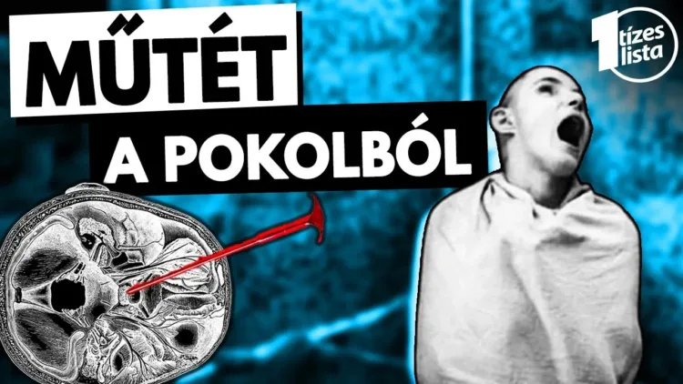Az orvostudomány sötét oldala - A LOBOTÓMIA - videó Az orvostudomány sötét oldala – A LOBOTÓMIA – videó