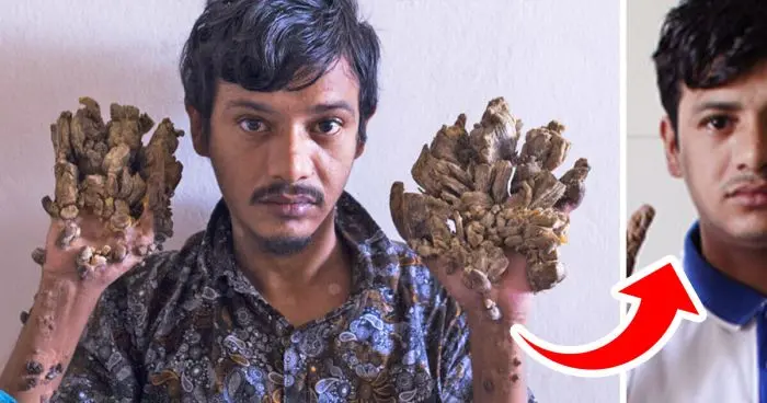 A “Faember” 16 műtéten esett át, hogy újra karjaiban tarthassa A „Faember” 16 műtéti út: Újra lányát ölelheti karjaiban