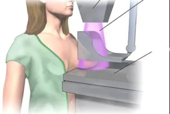 Egy orvos megdöbbentő őszintesége a mammográfiáról, amit minden