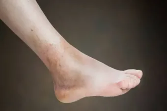 Lábdagadás elleni recept, ami azonnal hat!