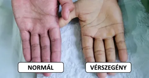 A vérszegénység 7 rejtett tünete és 7 természetes gyógymód