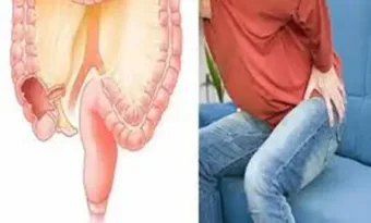 A végbélrák 7 kezdeti tünete, melyek nem kaphatnak elegendő figyelmet