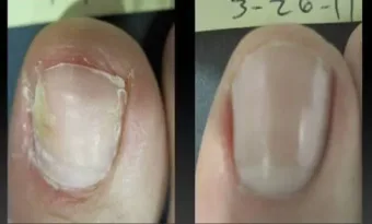 Így szabadulj meg 15 perc alatt a körömgombától! Nekem bevált!