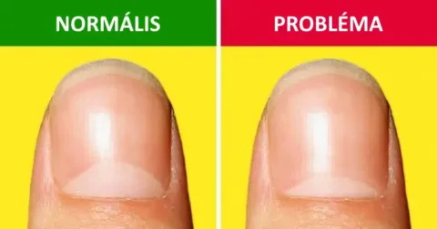 13 egészségügyi probléma, melyek a körmükön lévő kis fehér félhold segítségével észlelhetők