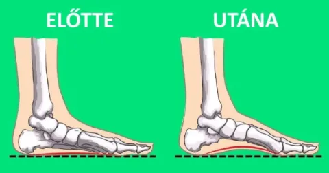 7 lépés a lábboltozat erősítéséhez és korrekciójához – Ortopédusok tanácsai