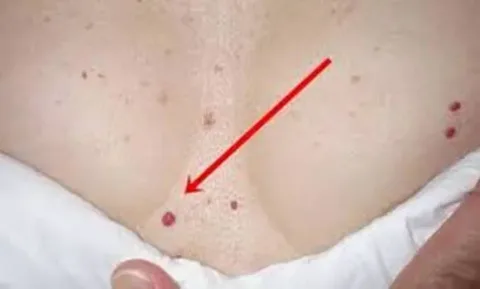 Rajtad is vannak ilyen piros pöttyök? Ha igen, akkor erről Ilyen piros pöttyök vannak a bőrödön? Mindenképp tudnod kell ezekről!