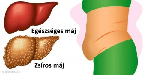 6 figyelmeztető jel, hogy a májad tele van méreganyagokkal 6 jel, hogy a májad túlterhelt: ideje méregteleníteni