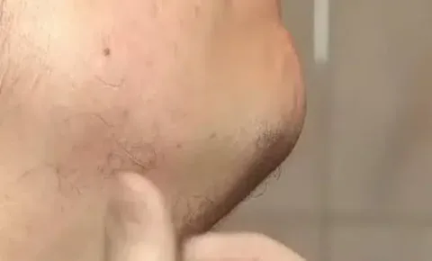 Üzenet minden nőnek! Súlyos bajt is jelezhet, ha szőrszál nő Van szőrszál az álladon? Vigyázz, mert komoly problémákra utalhat!