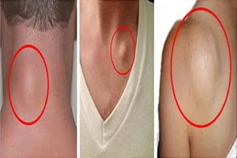Ha neked is vannak zsírdaganataid, ezekkel a módszerekkel megszabadulhatsz tőlük! Lipómák elleni küzdelem – természetes módszerekkel szabadulj meg a zsírdaganattól!