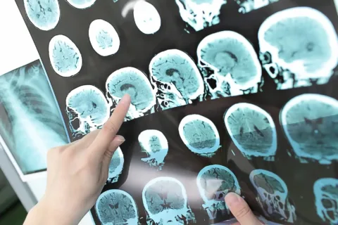 Ijesztő és gyógyíthatatlan: az Alzheimer-kór tényei és a küzdelem ellene